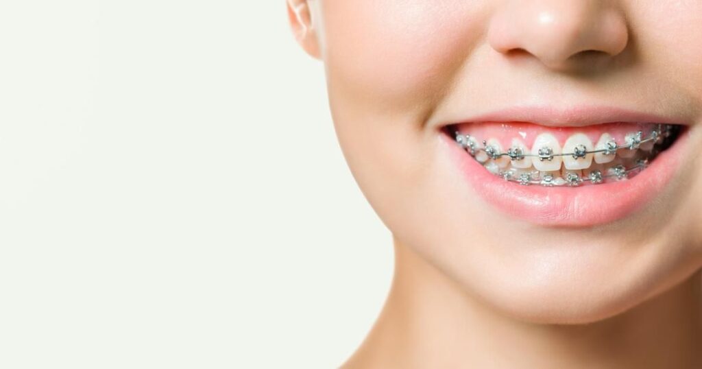 Understanding What Braces Are